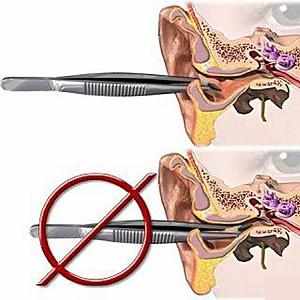 удаление инородного тела из уха