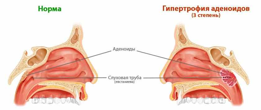 гипертрофия лимфоидной ткани носоглотки у взрослых