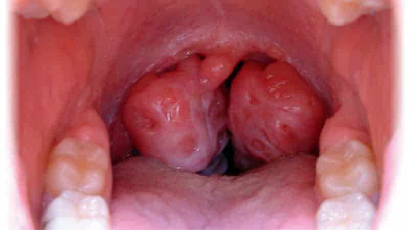 Как лечить туберкулез горла