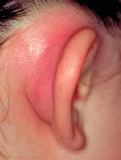 Рожистое воспаление уха