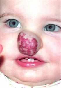 гемангиома на носу у ребенка