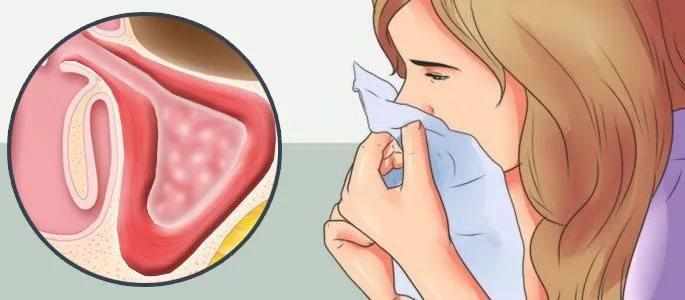 воспаление слизистой оболочки носа без насморка