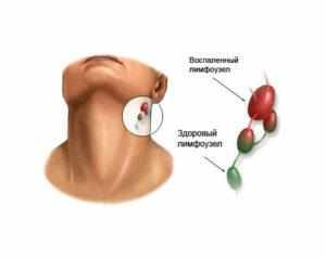 воспаление лимфоузлов за ухом у ребенка