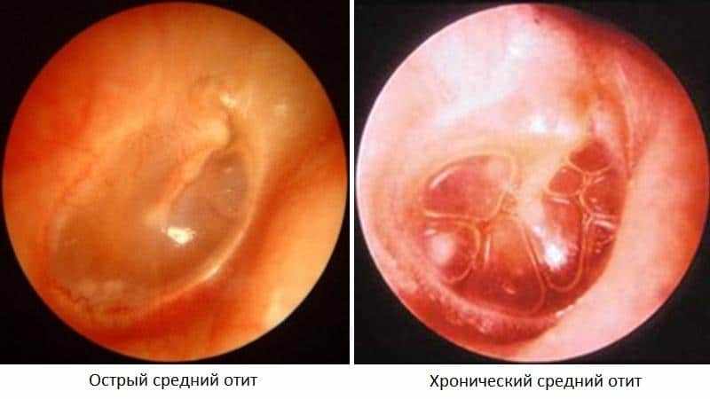 воспаления среднего уха лечение