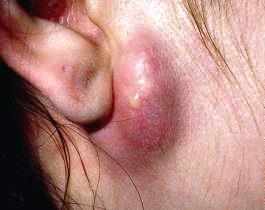 Причины и лечение пульсирующего шума в ухе.