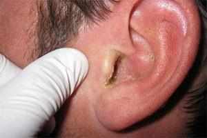 грибок в ушах симптомы лечение фото