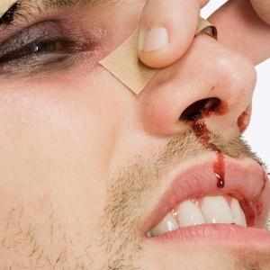 причины кровотечения из носа