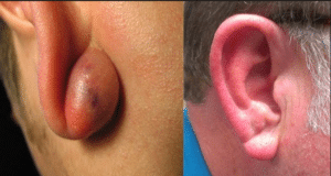 почему после прокола ушей образуются шишки