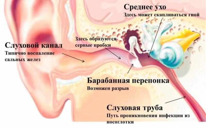 сульфацил натрия в уши при отите