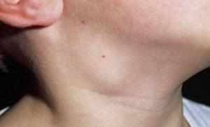 увеличенный лимфоузел за ухом у ребенка
