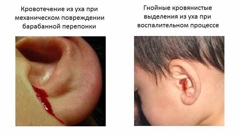 перфорация ушной перепонки
