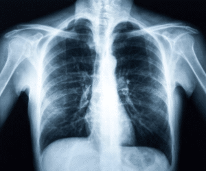 Что показывает рентген грудной клетки