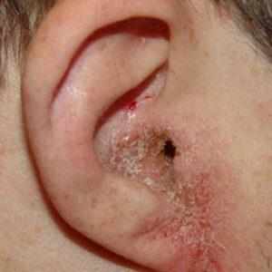 -острые воспалительные заболевания наружного уха