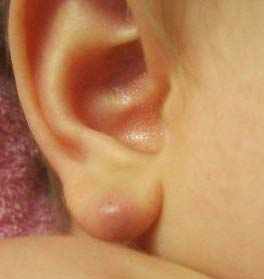 почему после прокола ушей образуются шишки
