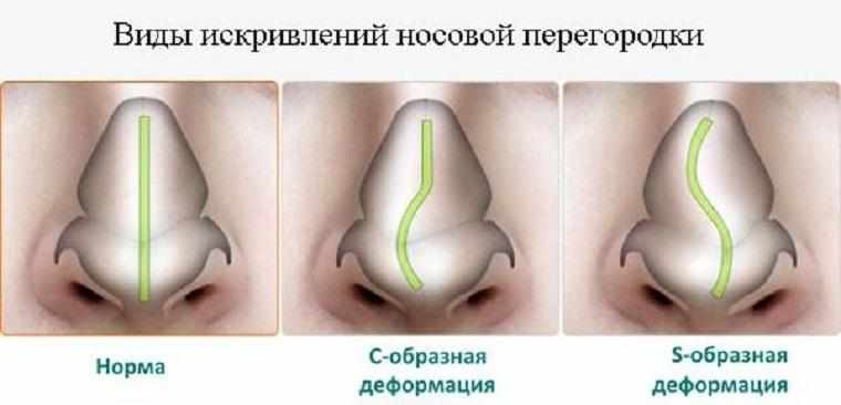 выпрямление перегородки носа