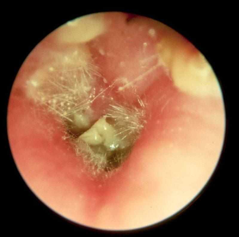 Как лечить отомикоз ушей