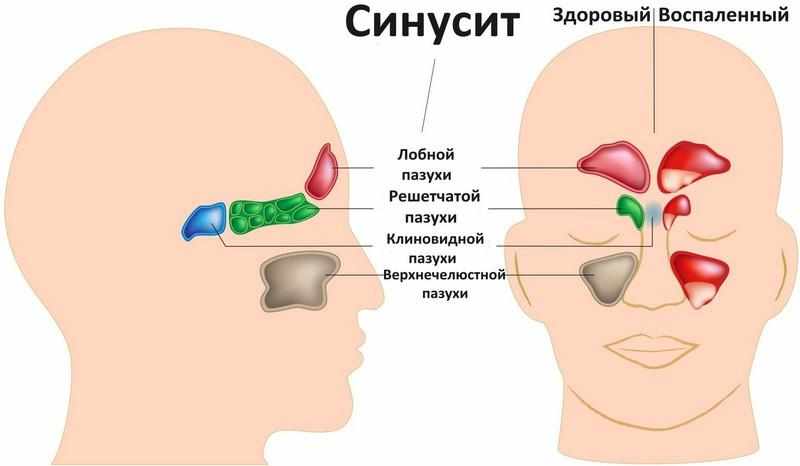 Как вылечить хроническую заложенность носа?