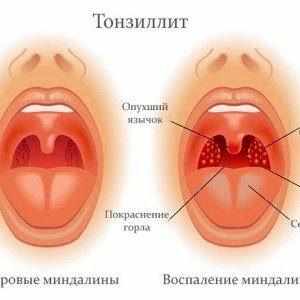 Как принимать «Эритромицин» при ангине