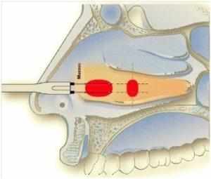 радиоволновая вазотомия нижних носовых раковин 