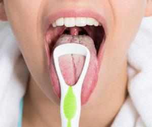 Лечение кандидоза полости рта
