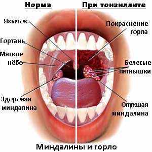 Что такое миндалины в горле