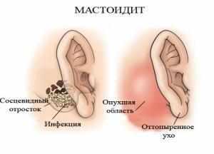 симптомы болезни среднего уха-5