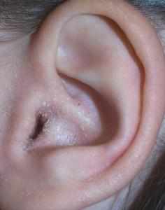 грибок в ушах симптомы лечение фото