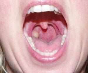 Как лечить папилломы в горле