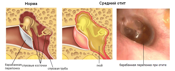суспензия гидрокортизона в ухо