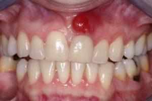 гайморит после удаления зуба