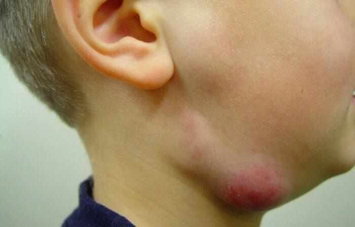 опухоль возле уха на щеке у ребенка
