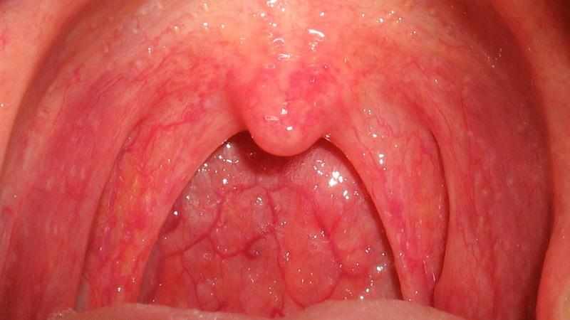 Как лечить стрептококк в горле
