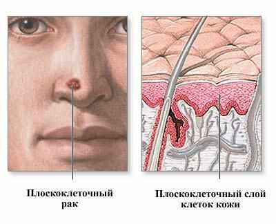 - симптомы и лечение рака кожи носа