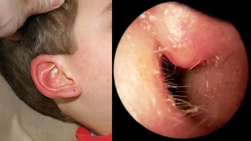 воспаление ушного прохода