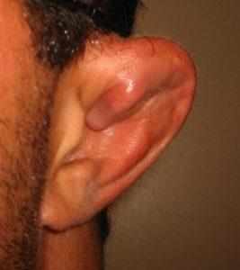симптомы сломанного уха фото