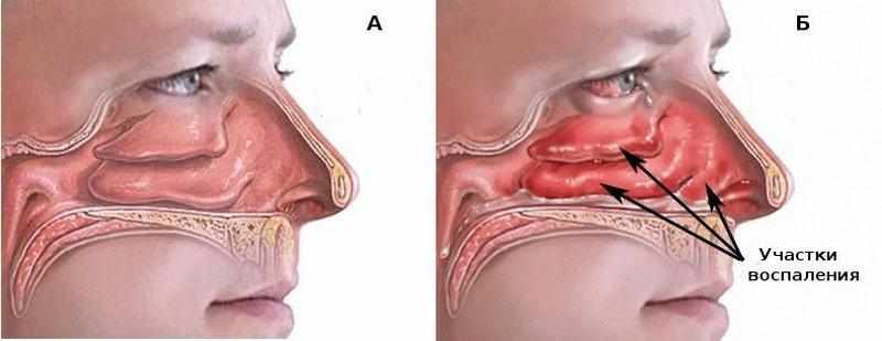 гормональные капли от заложенности носа