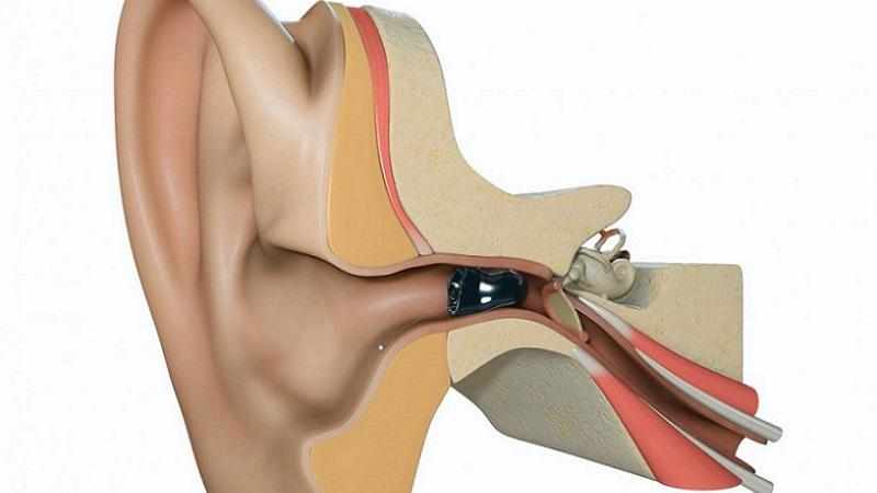 Внутриканальные слуховые аппараты глубокого погружения