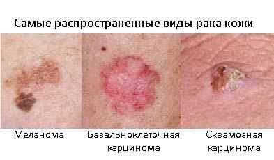-плоскоклеточный рак кожи носа