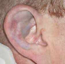 сломанное ухо как лечить