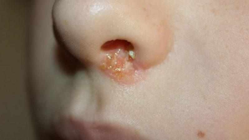 герпес в носу симптомы и лечение быстро