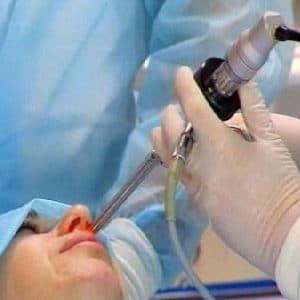 как делают операцию по исправлению носовой перегородки
