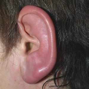 воспаление внешнего уха
