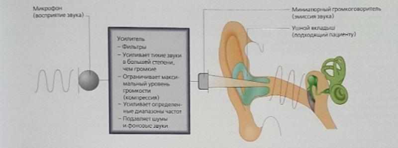 слуховой аппарат принцип работы