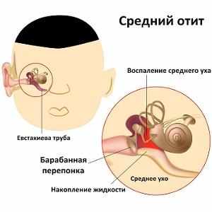 воспаление среднего уха