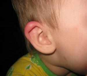 покраснение за ухом у ребенка