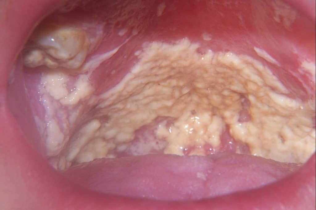 грибок в горле симптомы и лечение фото