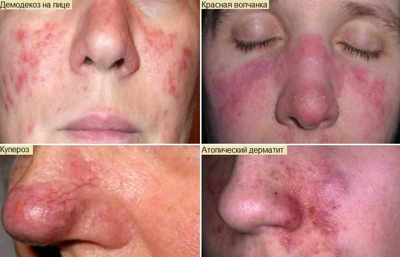 причины и лечение красного носа
