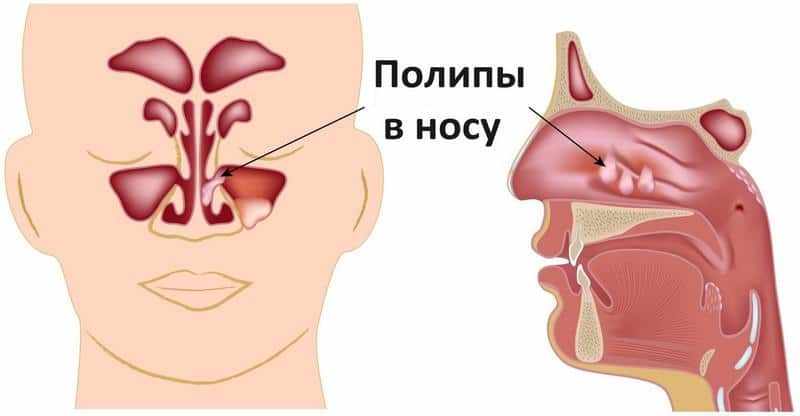 причины хронической заложжености носа