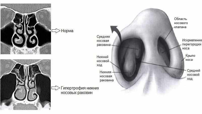 признаки и лечение гипертрофии носовых раковин 
