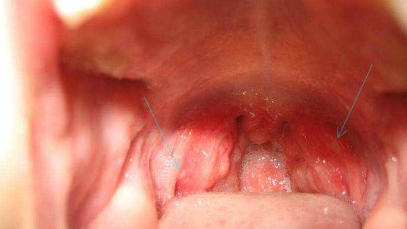 Лечение стоматита в горле